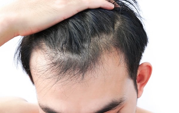 Các nguyên nhân rụng tóc nhiều phổ biến nhất 2