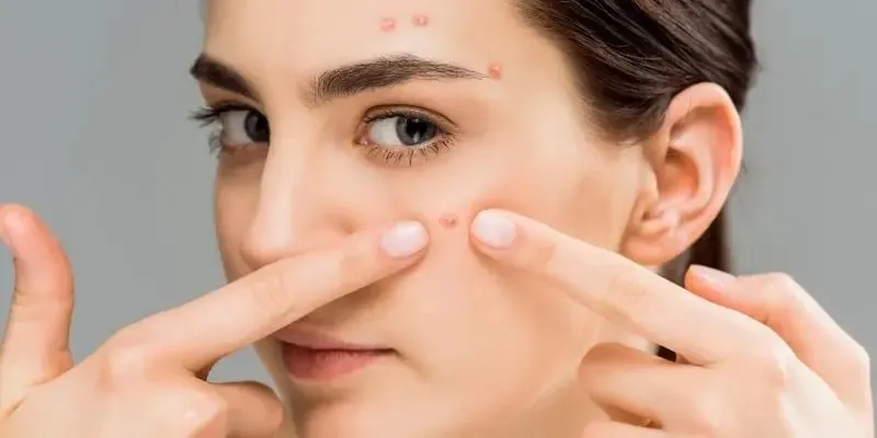 Cách điều trị mụn ở tuổi dậy thì - Những điều nên và không nên làm 1