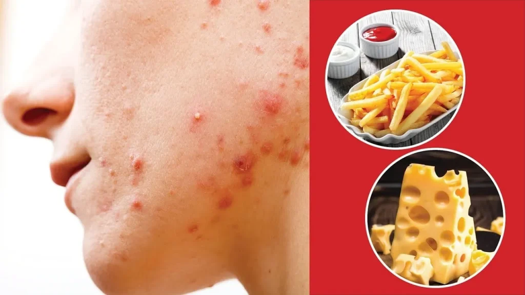 Cách điều trị mụn ở tuổi dậy thì - Những điều nên và không nên làm