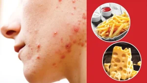 Cách điều trị mụn ở tuổi dậy thì - Những điều nên và không nên làm 2