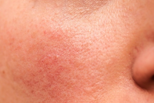 Thực hư câu chuyện trị nám bằng nhựa đu đủ xanh 3